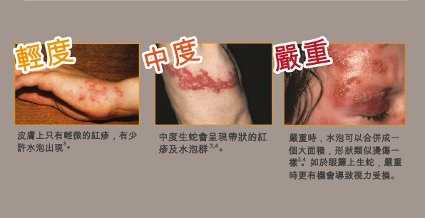 带状疱疹后遗神经痛严重吗？